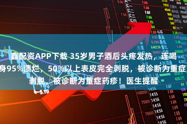鑫配资APP下载 35岁男子酒后头疼发热，连喝3次布洛芬后全身95%溃烂，50%以上表皮完全剥脱，被诊断为重症药疹！医生提醒